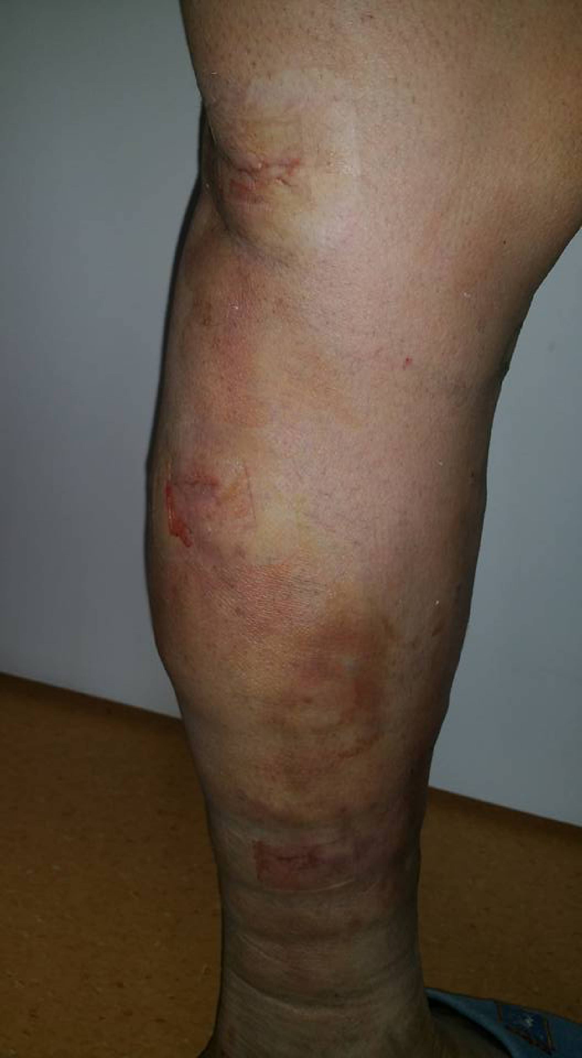 inflamația țesutului conjunctiv vene varicoase genunchi artroza cum se tratează